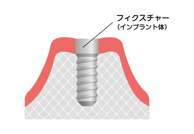 インプラント体(人工歯根)