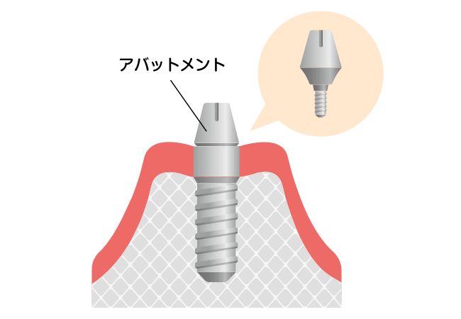 アバットメント(連結部分)