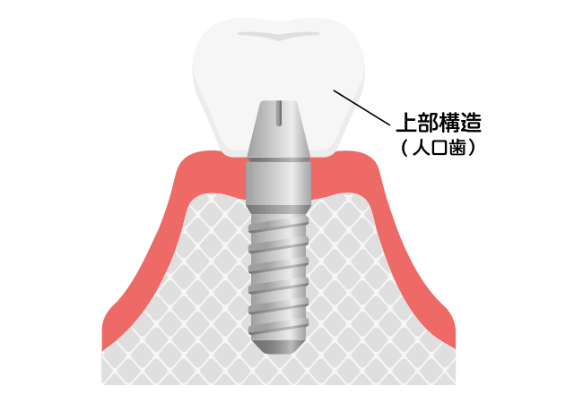 上部構造(人工歯)
